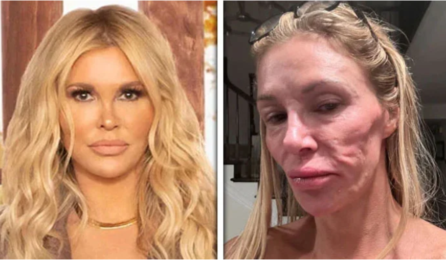Former American model Brandi Glenn Weil suffers from mysterious skin disease