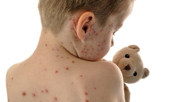 Record measles cases reported in US