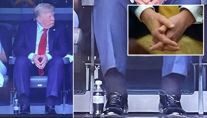 Trump's lower legs have swelling