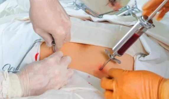 When is a stem cell transplant necessary