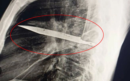 Doctors were stunned to learn the cause of a citizen who came to the hospital complaining of a pricking sensation in his chest