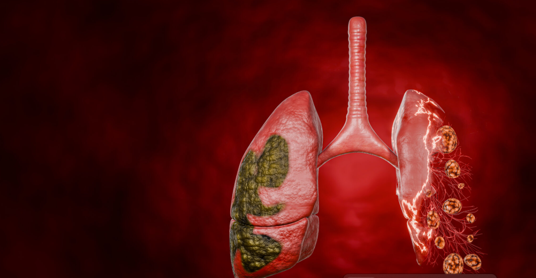 Ultra-processed foods may increase lung cancer risk by 41 percent