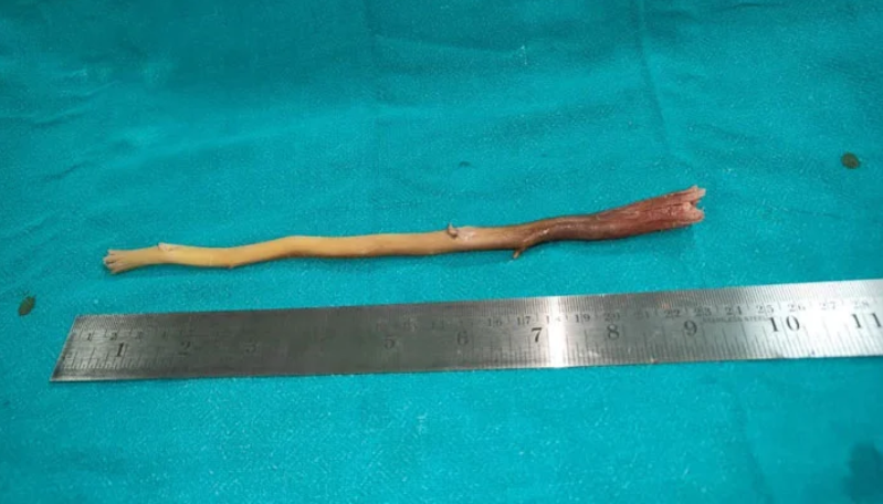 9-inch-long toothpick removed from 80-year-old man's esophagus