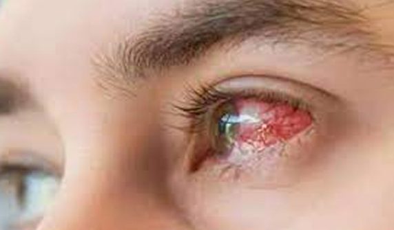 Conjunctivitis epidemic spreads in Karachi