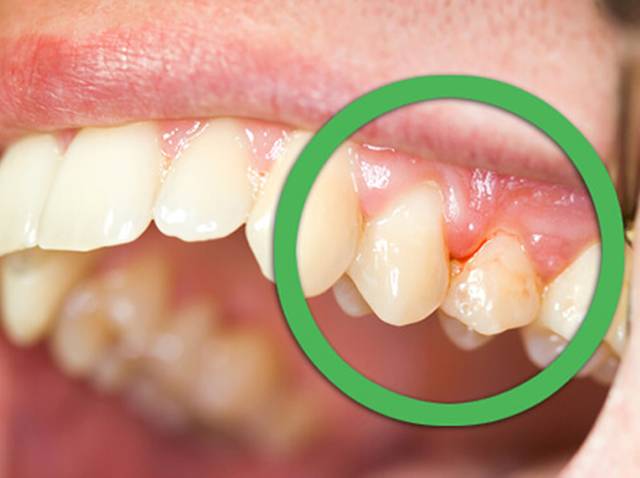 What foods can prevent gum disease