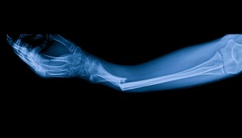 Glue developed to connect bones