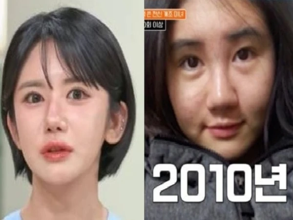Woman who spent over 50 million rupees on 400 plastic surgeries