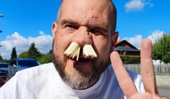 Unique record of 81 matchsticks stuck in nose