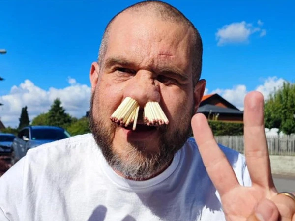 Unique record of 81 matchsticks stuck in nose