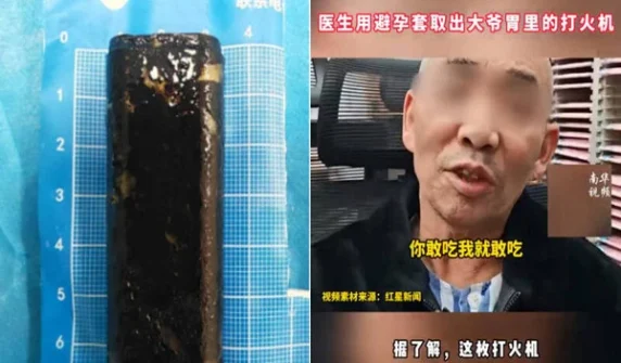 Active lighter recovered from citizen's stomach after 30 years