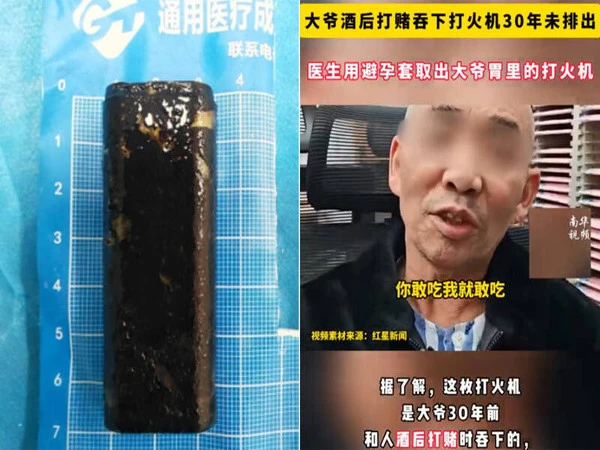 Active lighter recovered from citizen's stomach after 30 years