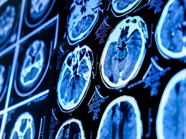 Blockage in the brain's nerve waste drainage
