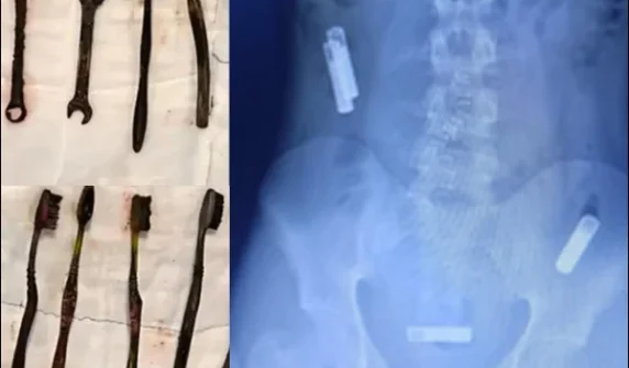 7 toothbrushes and a wrench were found in a young man's stomach