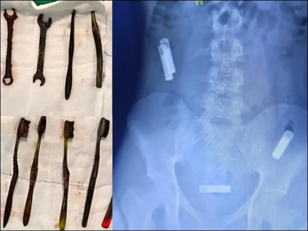 7 toothbrushes and a wrench were found in a young man's stomach