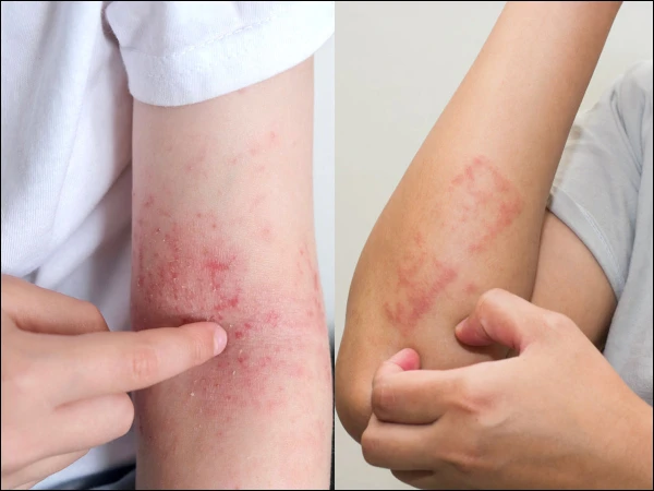 How to tell the difference between winter itch and eczema?
