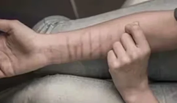 Mysterious deep wound marks on the hands of 35 school students