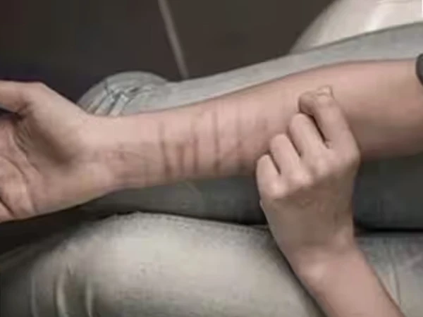 Mysterious deep wound marks on the hands of 35 school students