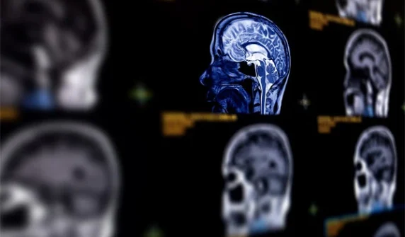 Major breakthrough in early diagnosis of Alzheimer's with AI technology