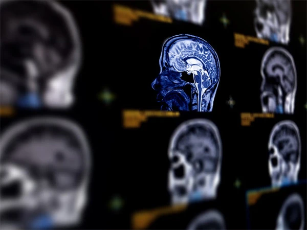 Major breakthrough in early diagnosis of Alzheimer's with AI technology