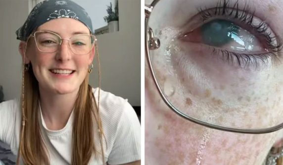 Girl who bathed wearing contact lenses loses sight in both eyes