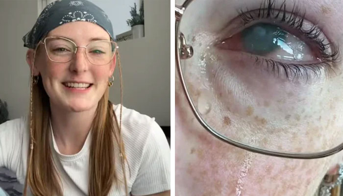 Girl who bathed wearing contact lenses loses sight in both eyes