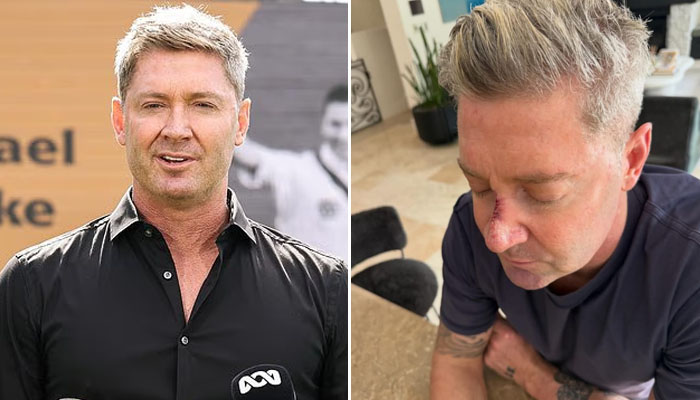 Another skin cancer removed from his face