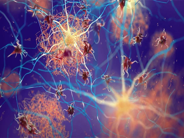 Increasing a protein may make the brain stronger in fighting Alzheimer's