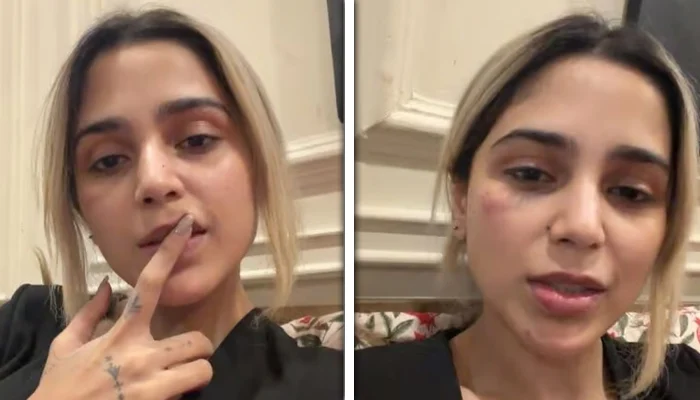 Aima Baig reveals the reason behind her facial injury