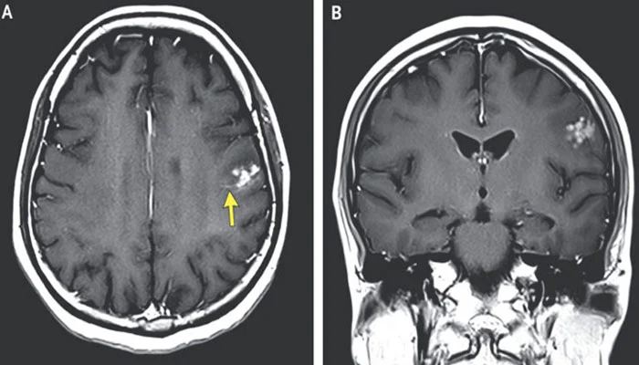 Presence of dangerous worms in woman's brain